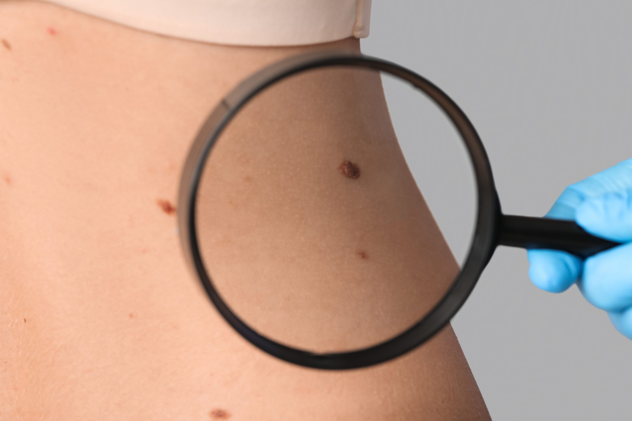 Das ABCDE-Schema: So lässt sich Hautkrebs frühzeitig erkennen